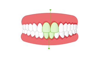 交叉咬合（クロスバイト）の画像