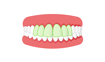 上顎前突（出っ歯）の画像