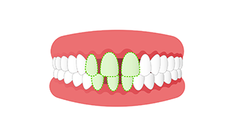 空隙歯列・正中離開（すきっ歯）の画像