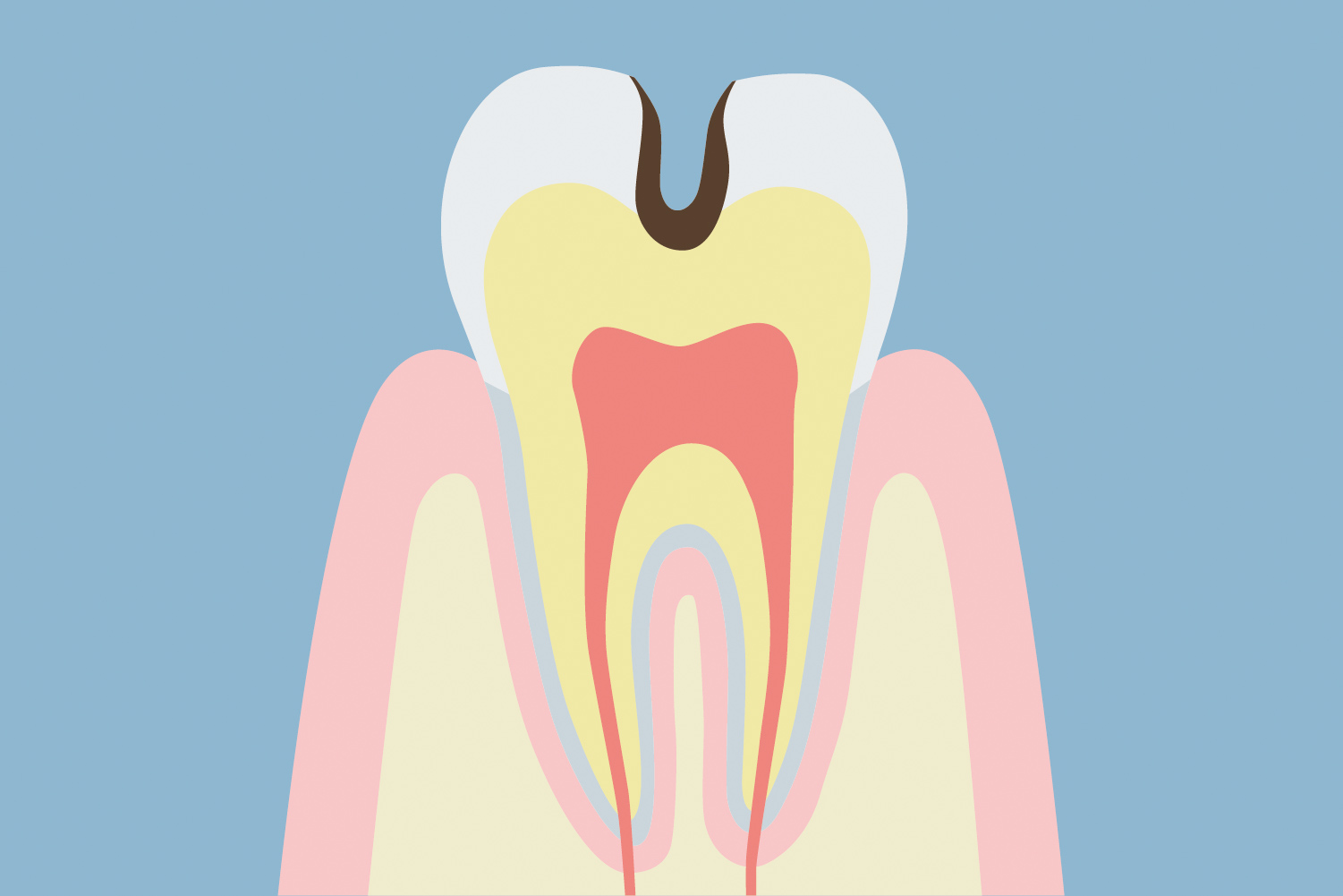 象牙質の虫歯
