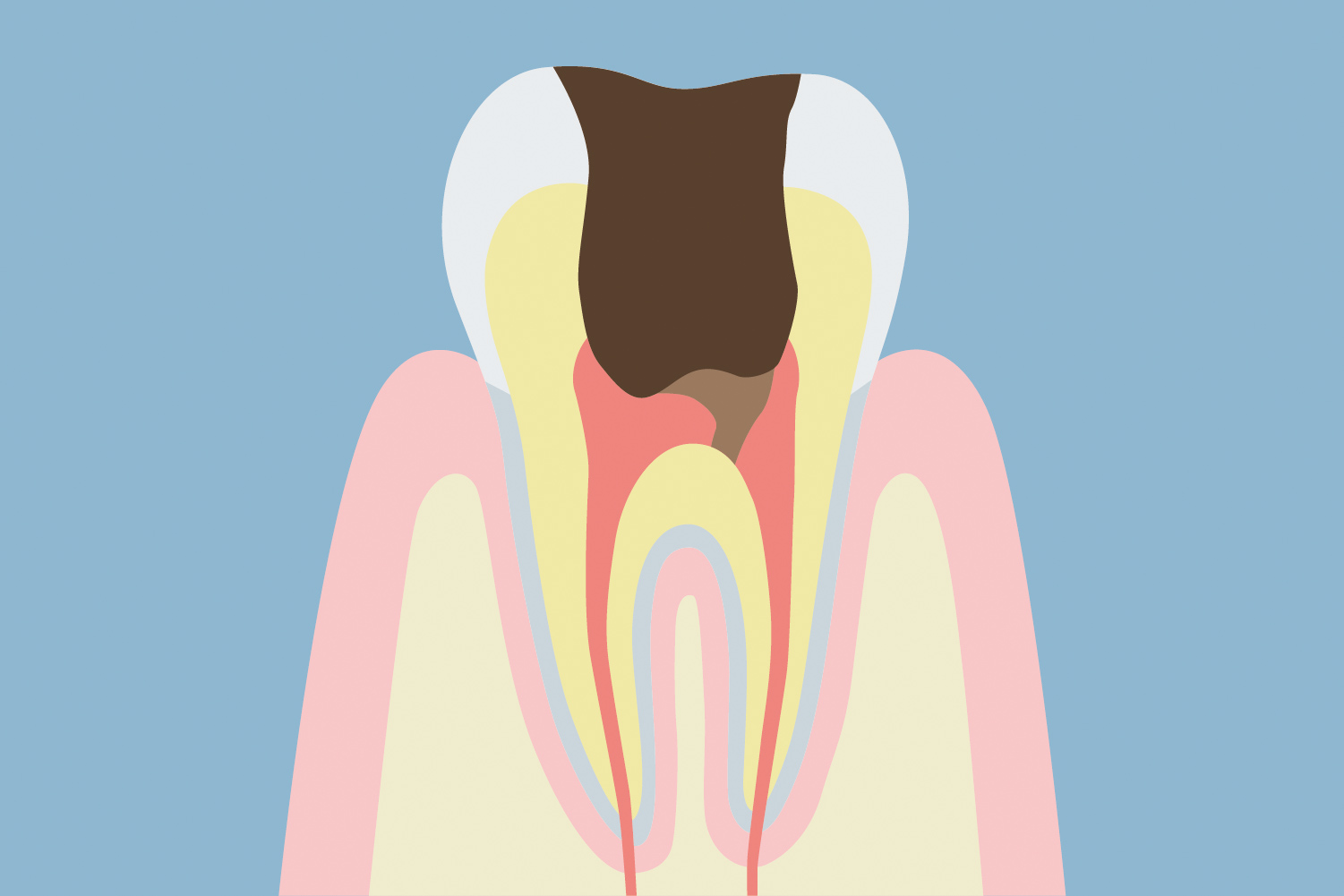 神経に達した虫歯