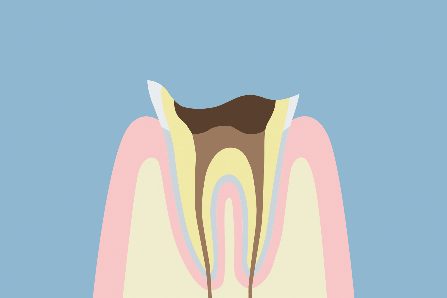歯根に達した虫歯