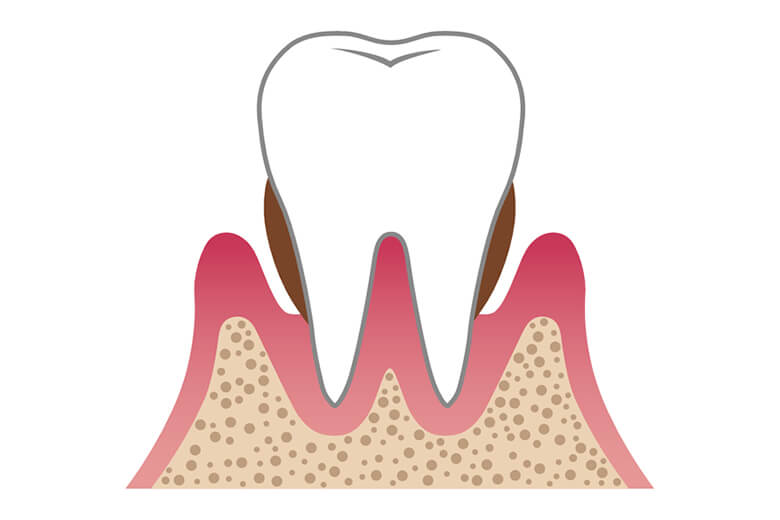 歯周炎中度