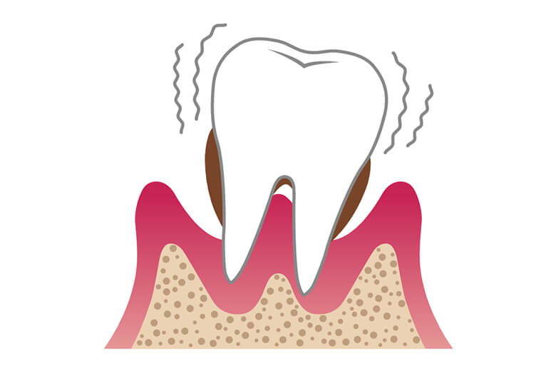歯周炎重度