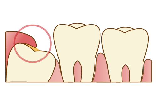 周りの歯ぐきなどの組織に影響を与えてしまう時