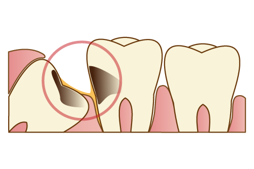 親知らず自身がむし歯や歯周病の時