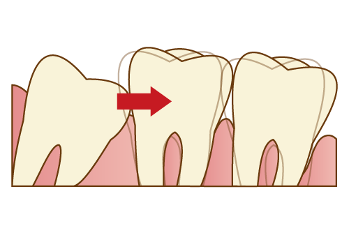 手前の歯を押して歯並びが変わってしまう時