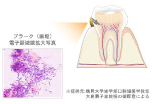プラーク（歯垢）と歯石とは？ ｜ 医療法人 徳真会グループ