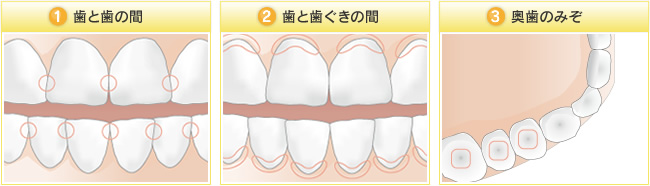 (1)歯と歯の間　(2)歯と歯ぐきの間　(3)奥歯のみぞ