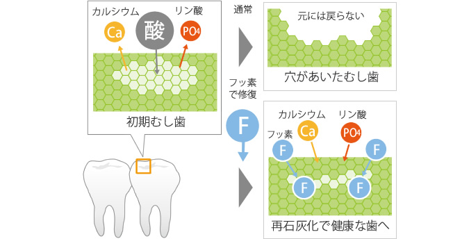 むし歯の進行