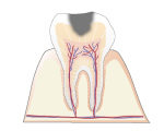 Ｃ２｜象牙質のむし歯