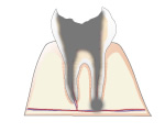 Ｃ４｜歯根のむし歯